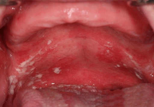 Mouth-Lesions-White-Spots-3