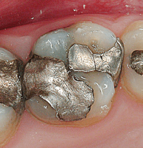 Silver-Fillings-Removed-1