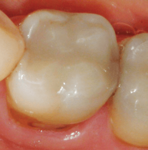 Silver-Fillings-Removed-4