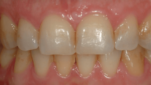 Teeth-Bleaching-2