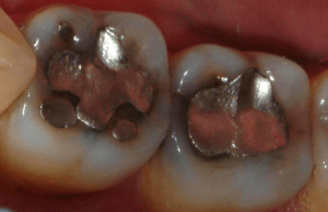 Tooth-Colored-Filling-1