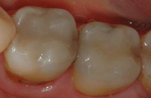 Tooth-Colored-Filling-2