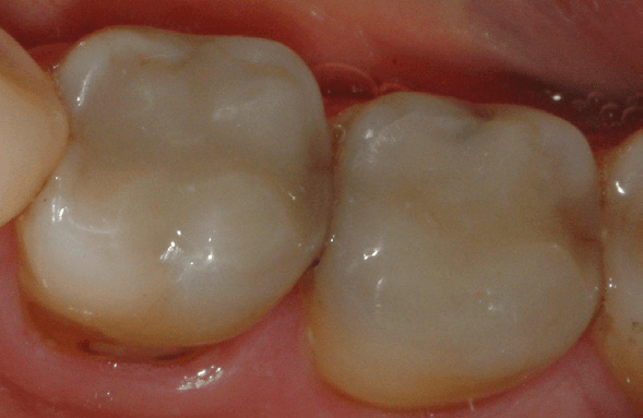 Tooth-Colored-Filling-2