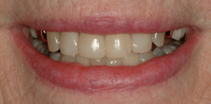 Tooth-Colored-Filling-41