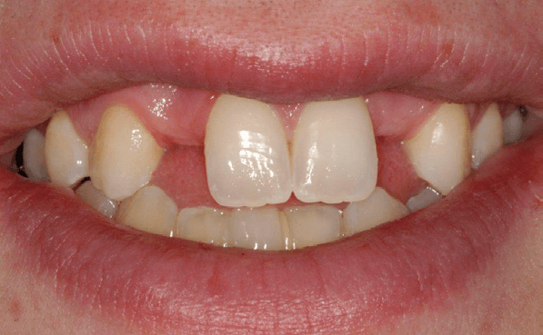 Tooth-Supported-Bridge-3