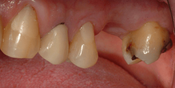 Tooth-Supported-Bridge-5