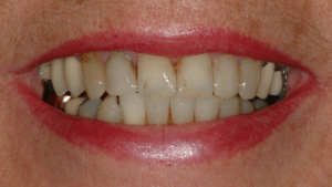Tooth-Supported-Crown-1