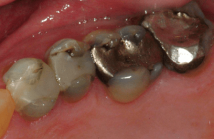 Tooth-Supported-Crown-3