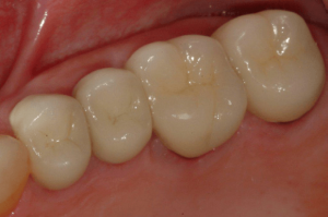Tooth-Supported-Crown-4