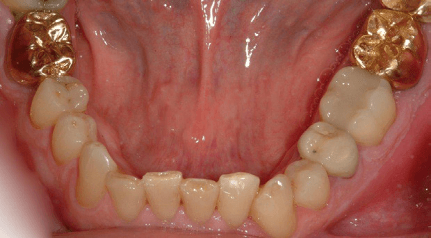 Tooth-Supported-Crown-5