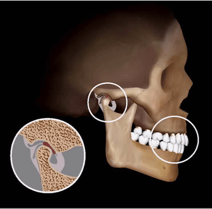 Treatment-of-TMJ