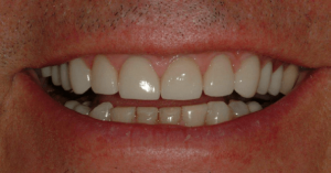 Veneers