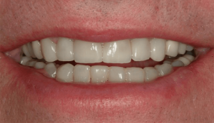 Teeth with veneers